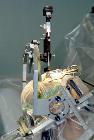 Le dispositif chirurgical de la DBS
