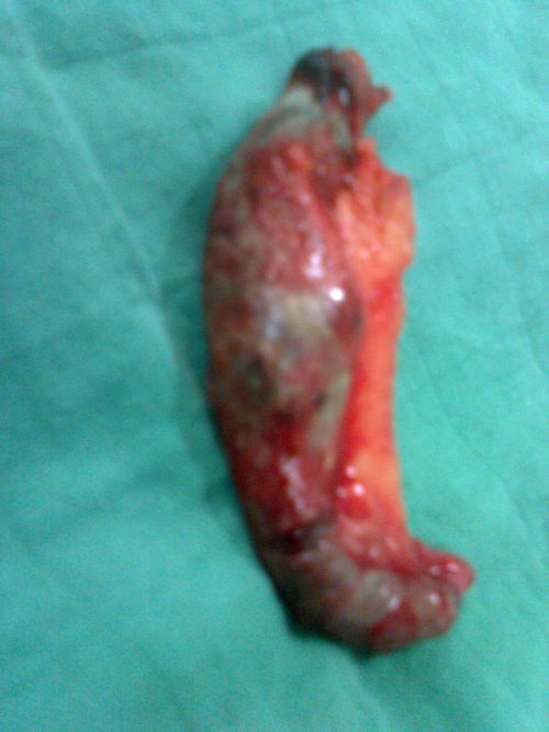 Appendicite gangrénée