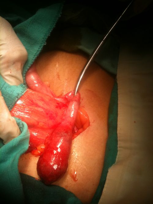 Vue opératoire d'une appendicectomie