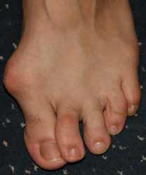 oignon du pieds.jpg