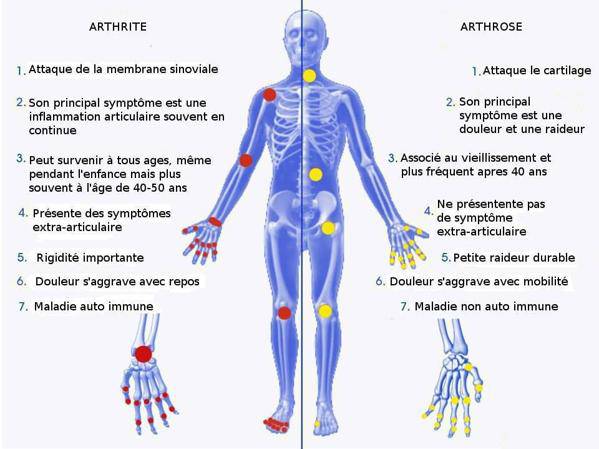 Différence entre arthrose et arthrite