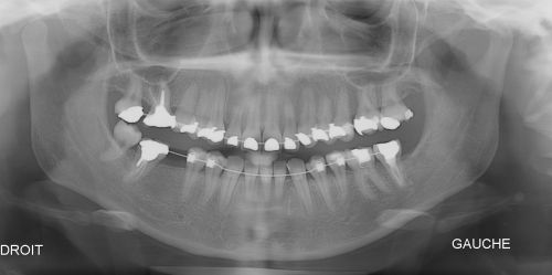 Avant : Panoramique dentaire