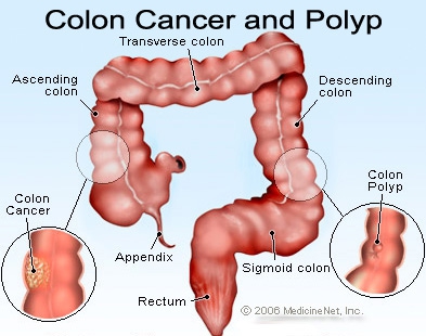 colon_cancer.jpg