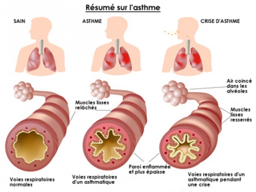 Asthme.jpg