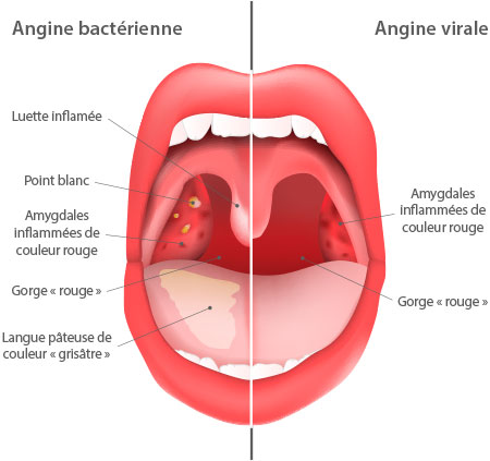 angine-bacterienne-ou-angine-virale.jpg