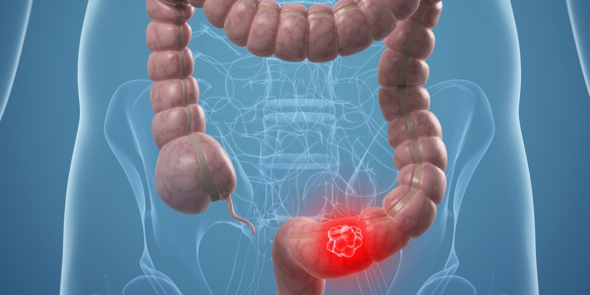 cancer-colon-shcema-intestin.jpg