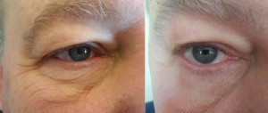 BeautyStrips-eye-Before-and-After2-300x127.jpg