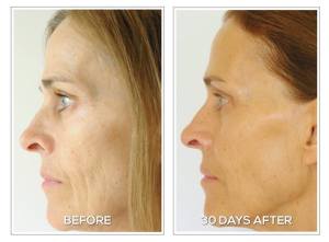 BeautyStrips-womens-face-Before-and-After-30-days-300x221.jpg