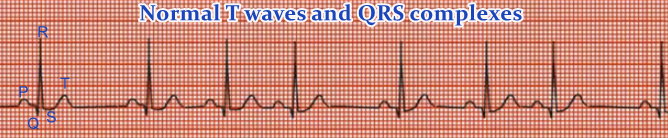 ECG Lead II - Labelled Normal Wave Components.jpg