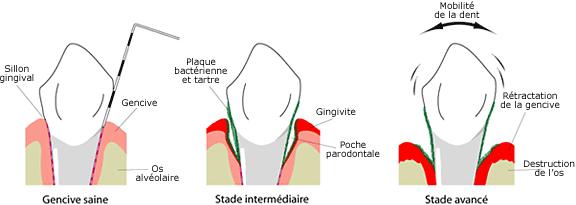 parodontite-julie-antoniutti.jpg