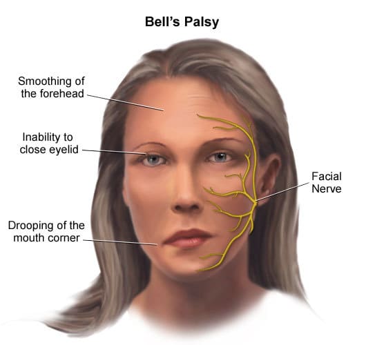 Bell's palsy treatment