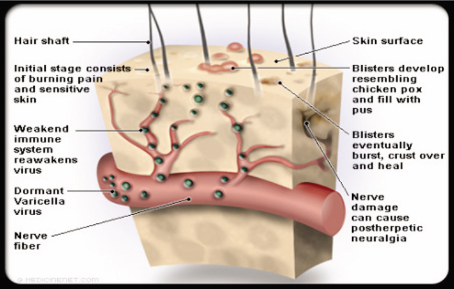 Shingles - Diagnosis and treatment