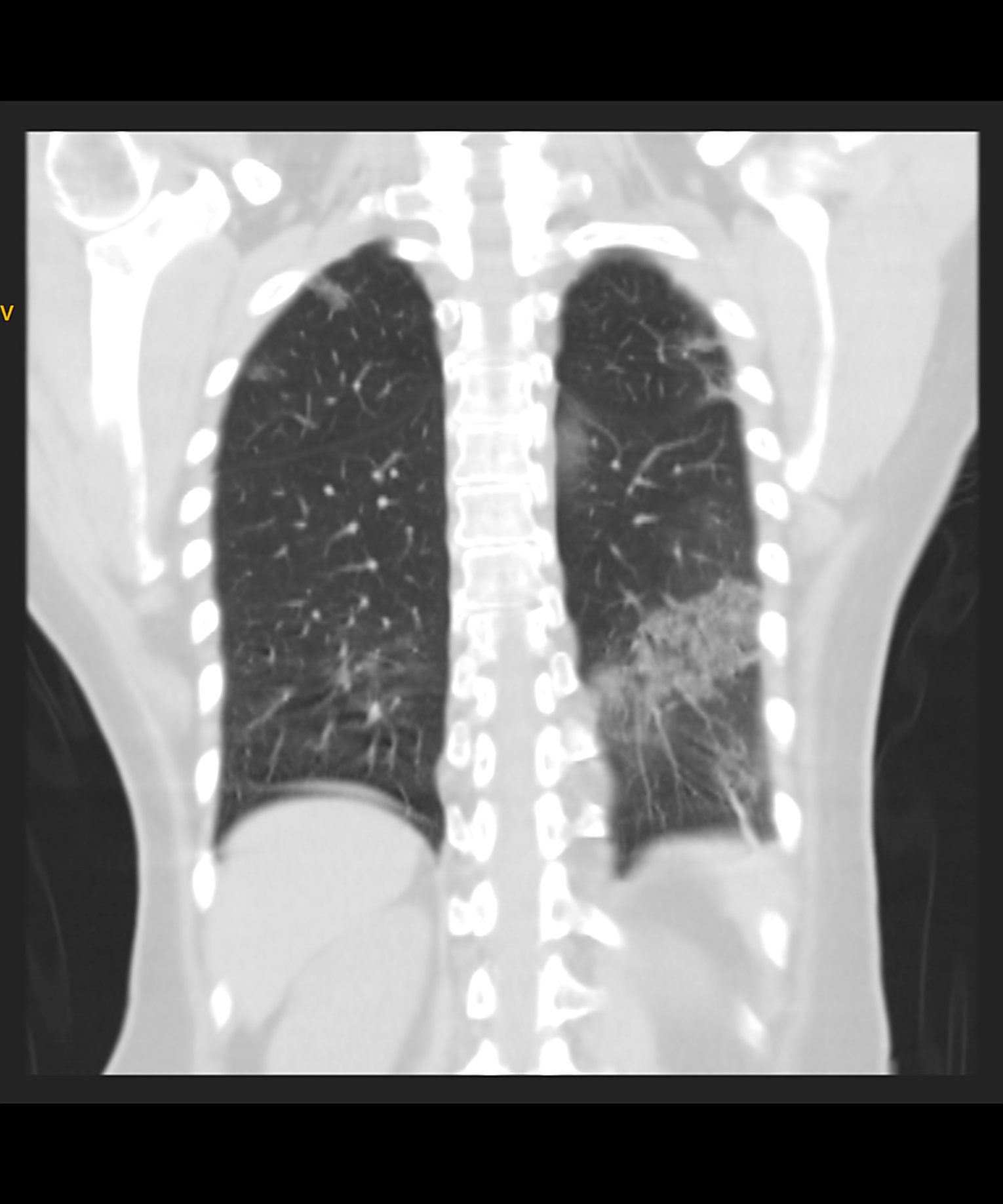 covid-19-pneumonia-2 (CT Scan)